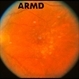 Dry Age-Related Macular Degeneration (AMD)